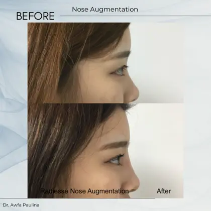 Nose Enhancement
