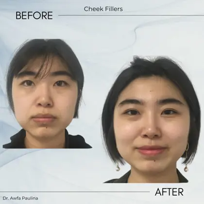 Cheek Filler 2 Sessions