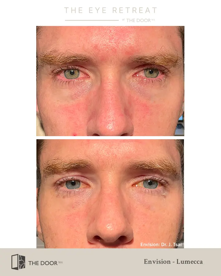 En Vision Ipl Lumecca-I Intense Pulsed Light (IPL) Therapy — The Door W4