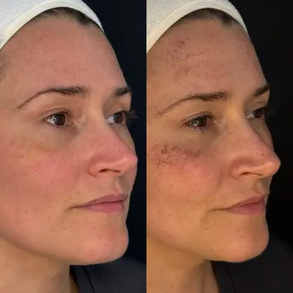 BBL, before and after 1 png.png