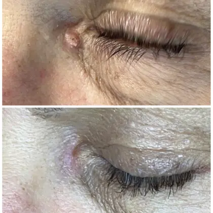 Medial Canthal Wart Removal With Plexr Sublimation Technology 2