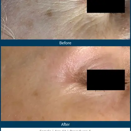 BA-SkinPen-FLAW-LG-CrowsFeet-ArizonaMicroneedling-5treatments-53YO.png (1)