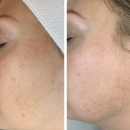 Reboot Peel Victoria Before And After