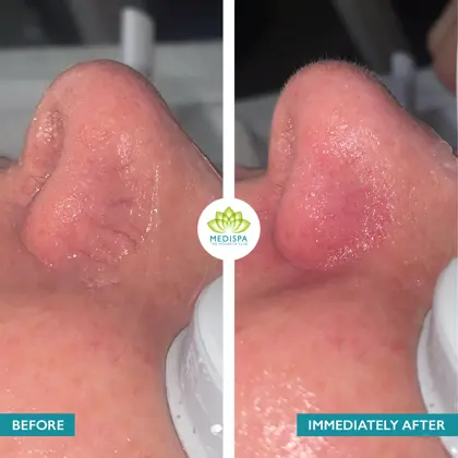 Before And After BBL Heroic Red Veins Nose Immediately After