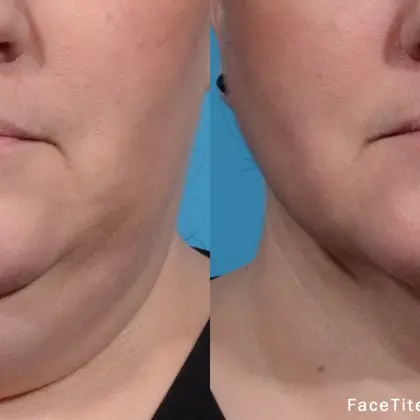 ED Facetitem8 1 Jowl