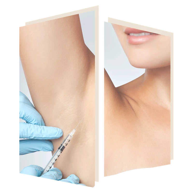 Treat excessive sweating with botox at the door w4