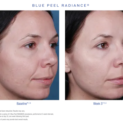 US BPR Before After 3 Small