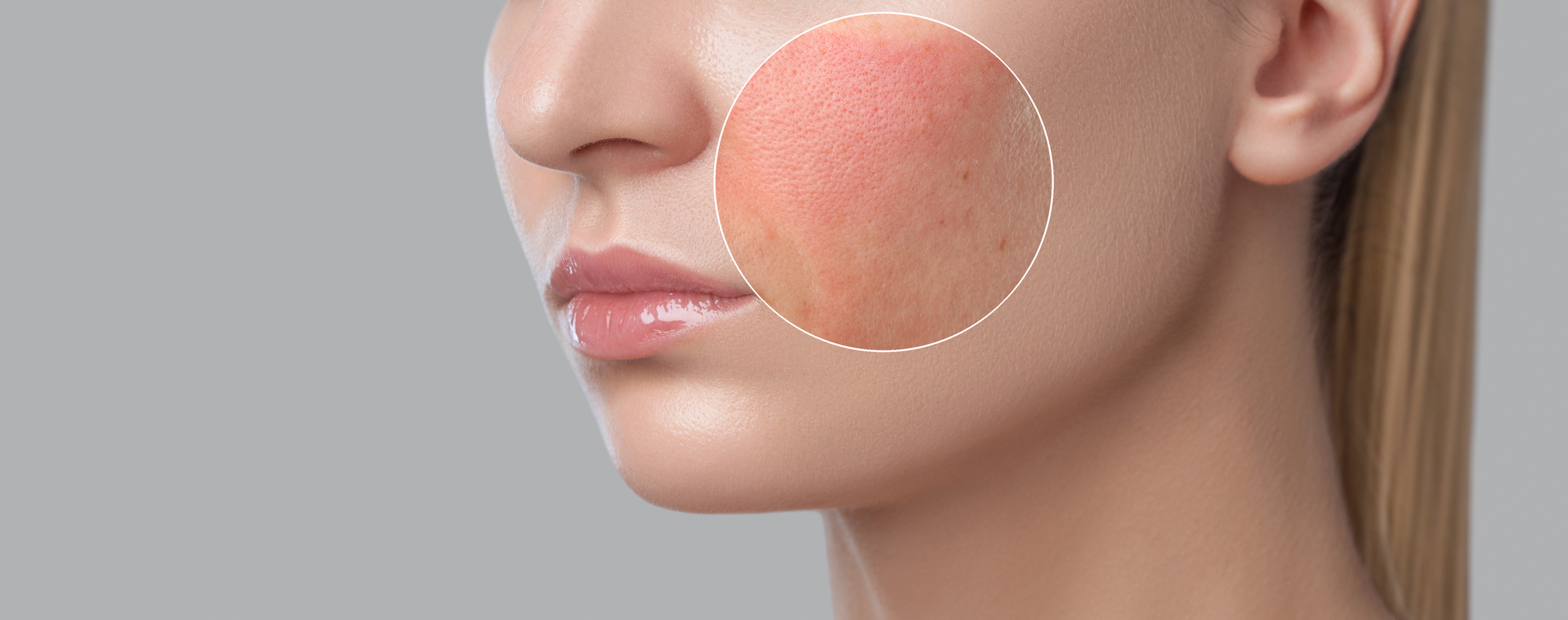 Rosacea