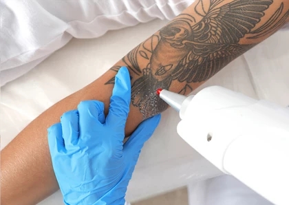 Laser Tattoo Removal