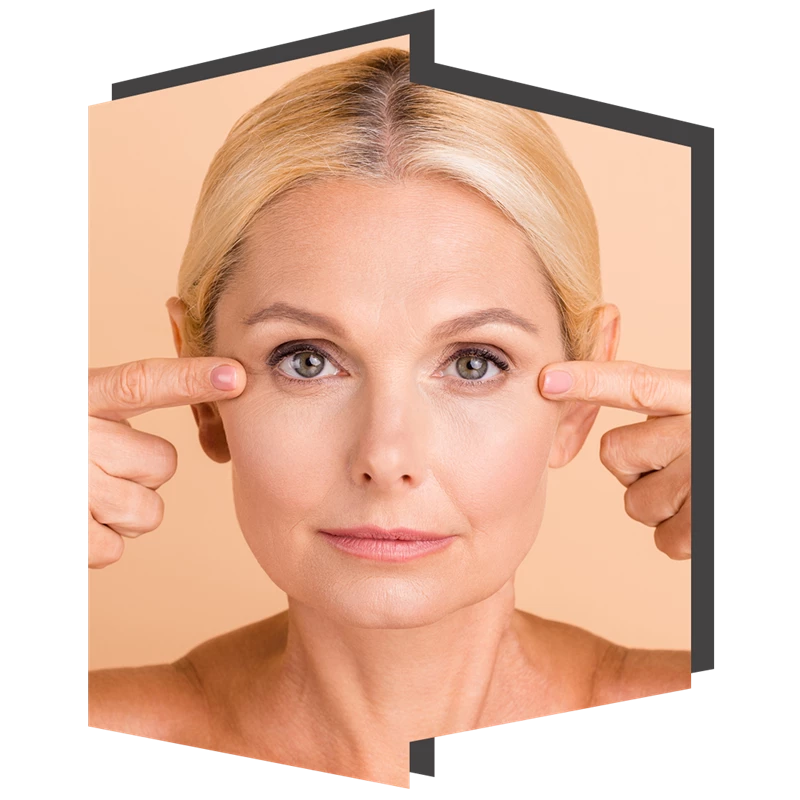Blepharoplasty