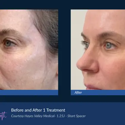 Agejet B&A Hayes Valley Medical Agejet Smooth Female 4