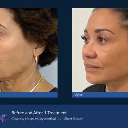 Agejet B&A Hayes Valley Medical Agejet Smooth Female 1