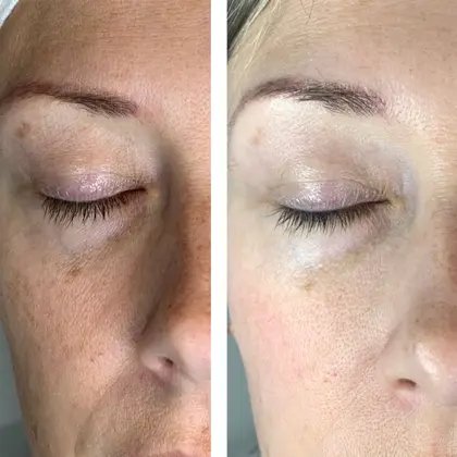 Reboot PEEL Eye Before And After
