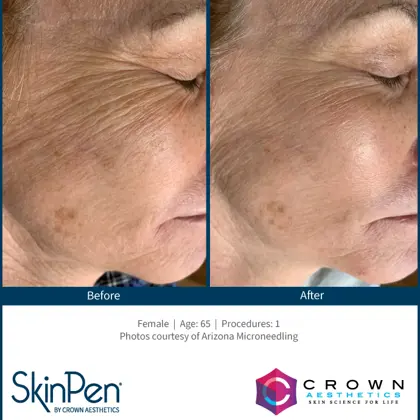 BA-SkinPen-FLAW-KH-Face-ArizonaMicroneedling-1treatment-65YO.png (1)
