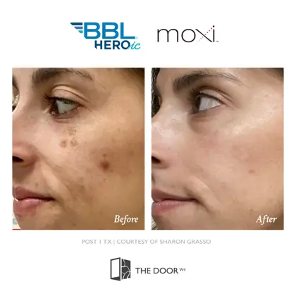 202605 Before and Afters, Sciton BBL Moxi-15.jpg (1)