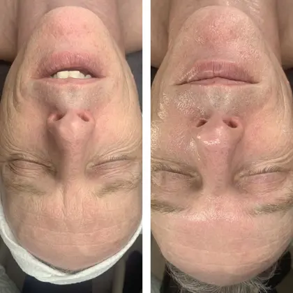 Fire N Ice Andy Before And After