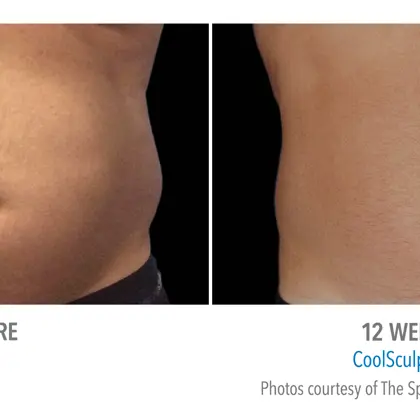 AB PLAS 145414145M(12W) FV 2Set