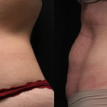 MC M8body 1C Abdomen