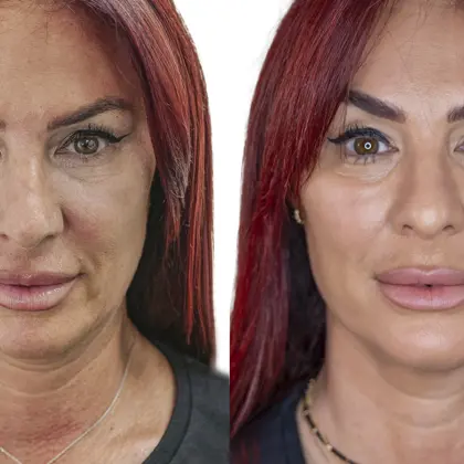 Dr Judy Todd Lauren Simon Full Frontal BEFORE AND AFTER FINAL OCT 2021 EDIT Copy