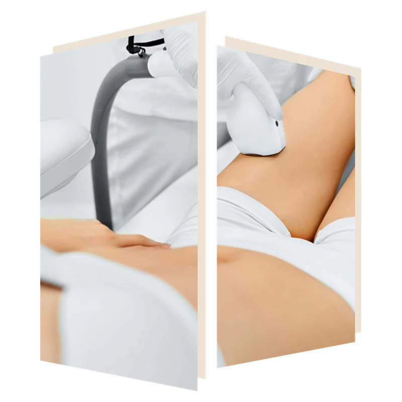 Ingrown Hairs treatable with Laser Hair Removal