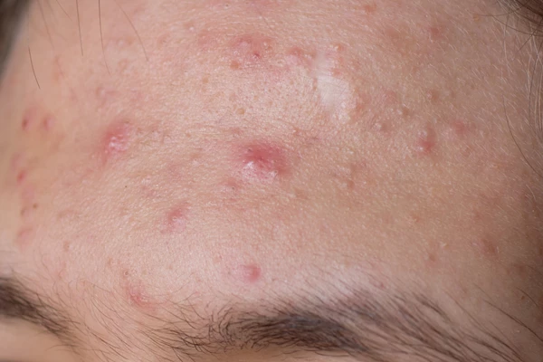 Acne