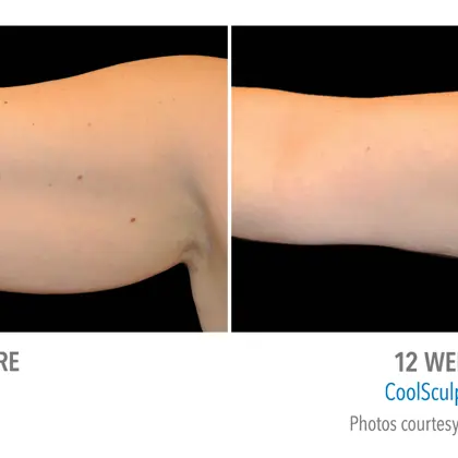 AR BREN 21660F(12W) FLV 2Set