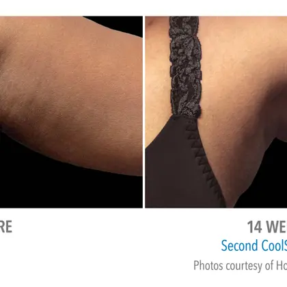 AX HONE 001F(14W) FRV 2Set