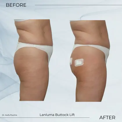 Lanluma Bum Filler