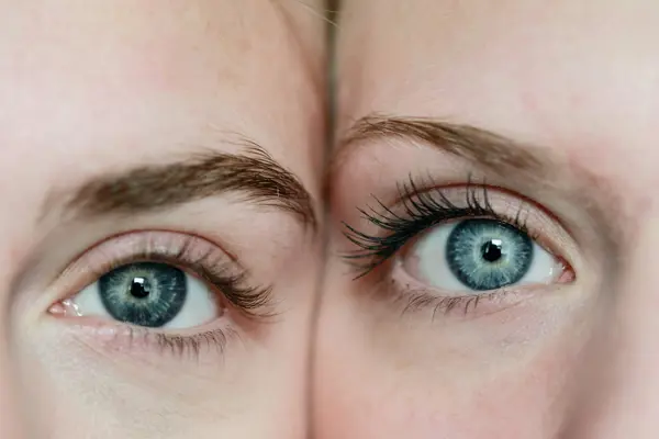 Upper Blepharoplasty