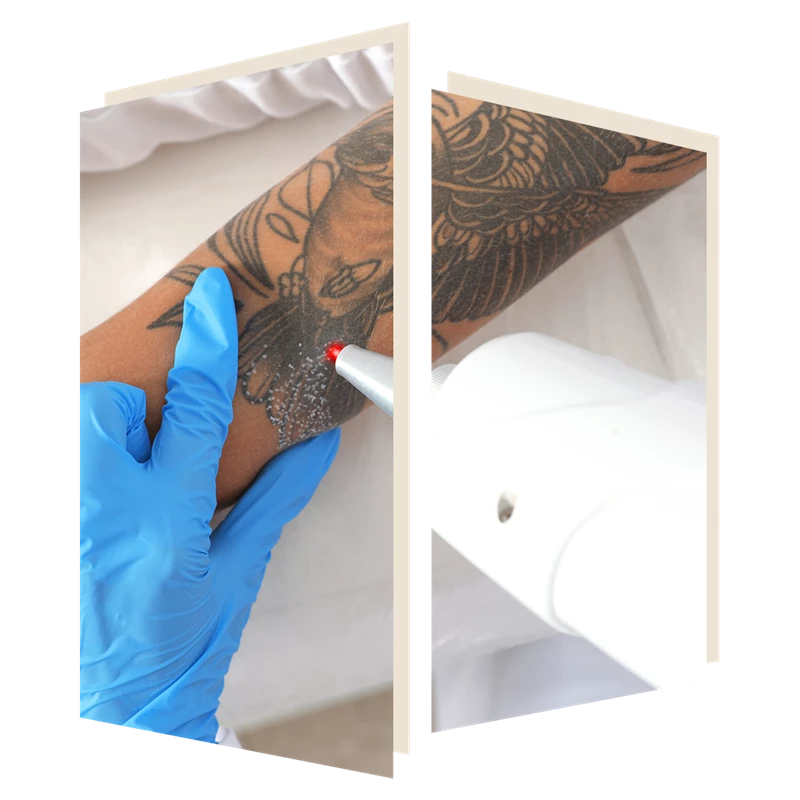 Laser Tattoo Removal at The Door w4