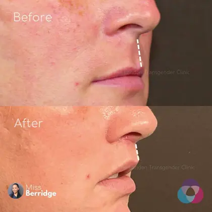 NB Before & After 2 (1)