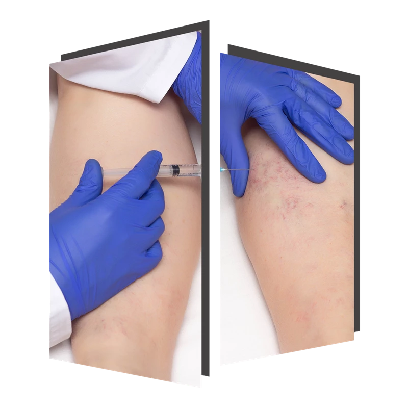 Microsclerotherapy for Thread Veins at The Door W4