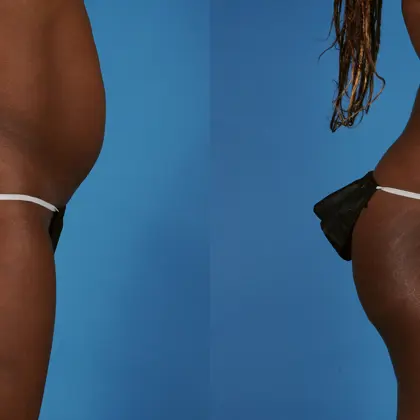 AT Bodytite 1D Abdomen