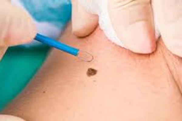 Skin Lesions: What Are They and How Can You Remove Them?