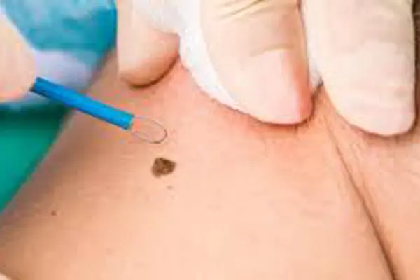 Skin Lesions: What Are They and How Can You Remove Them?