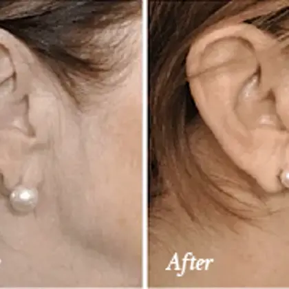 earlobe reconstruction before and after.jpg