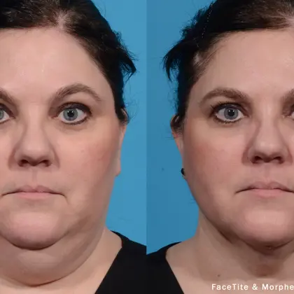 ED Facetitem8 1B Jowlfullface