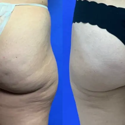 ZW Bodytite 2A Buttock