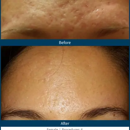 BA acne scars 1.jpg (1)
