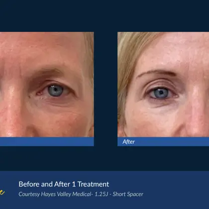 Agejet B&A Hayes Valley Medical Agejet Eye Female 3