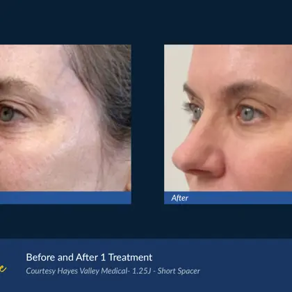 Agejet B&A Hayes Valley Medical Agejet Eye Female 4