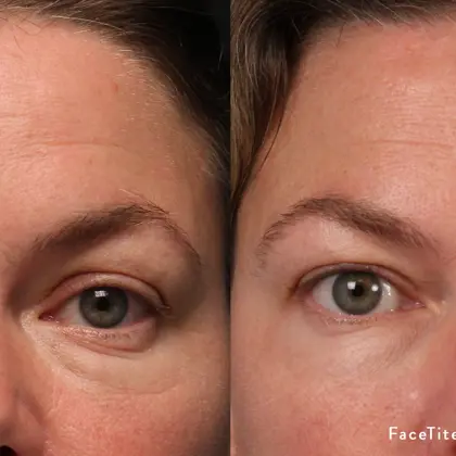 MC FTM8 2AA Upperface