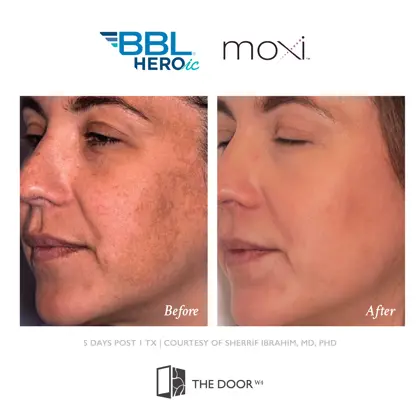 202605 Before and Afters, Sciton BBL Moxi-17.jpg (1)