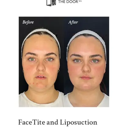 Before and after - molly facetite liposuction.jpg