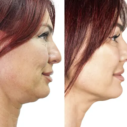 Dr Judy Todd Lauren Simon Before And After Right Profile Nov 2021 Copy