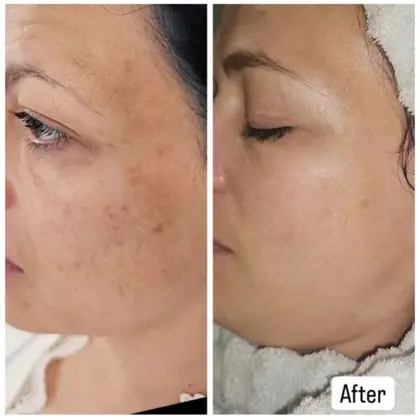 Before And After Infusion Lab Facial 1 (1)
