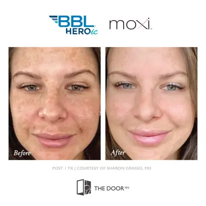 202605 Before and Afters, Sciton BBL Moxi-13.jpg (1)