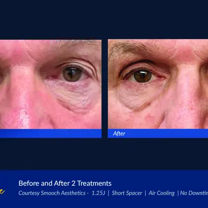 Agejet Eye Male Smooch Aesthetics