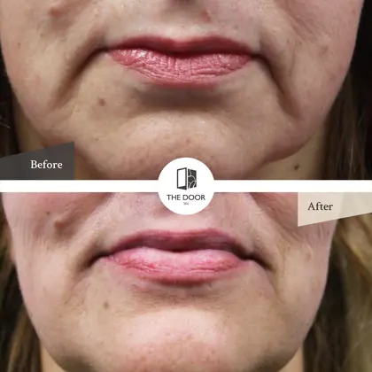 Marionette Lines Before And Afters Copy 2