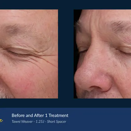 BA Agejet Eye Male Weaver